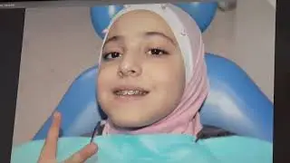 التقوم المريح للناب المطمور . Comfortable Ortho for Impacted Canine