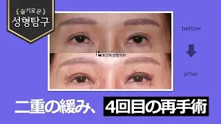 【韓国二重整形】二重の緩みで4回目の再手術