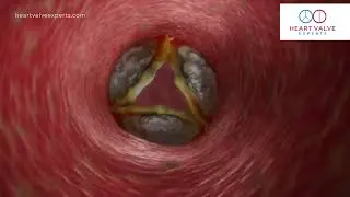 Aortic Stenosis - Symptoms, Diagnosis & Treatment | Heart Valve Experts