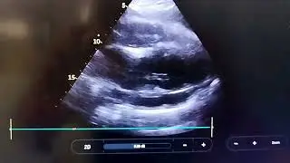 Massive Pericardial Effusion, Right Atrial collapse 