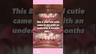 Invisalign is easy - even for an 8 year old child with an underbite