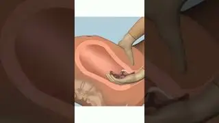 Manual removal of placenta.