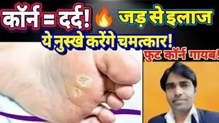 पैरों के कॉर्न को हमेशा के लिए कैसे ठीक करें? | Foot Corn Removal at Home