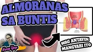 HEMORRHOIDS O ALMORANAS SA BUNTIS | LUNAS SA HEMORRHOIDS