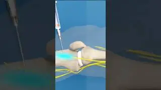 БЛОКАДА ЛЕЧЕНИЕ БОЛИ В КОЛЕНЕ l Genicular Nerve Blocks for Knee Osteoarthritis #колено #блокада