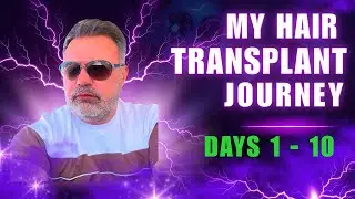 My Full Hair Transplant Journey: From Decision to Day 10 | FUE, Healing, Results & Transformation