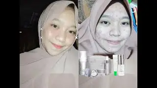 My Acne Story, Setelah Hampir setahun Pakai Ms Glow.