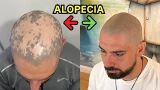 This alopecia treatment ACTUALLY worked!