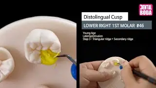 Lower Right 1st Molar distolingual cusp 3 ridge (young-aged) Wax-Up #46-3