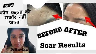 Injury scar on face | चोट के निशान का इलाज | best clinic for scars | स्कार को कैसे ठीक करें ? 