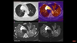 See the world&rsquo;s first and only detector-based spectral technology with Philips IQon Spectral CT