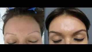 401. Eyebrow Transplant by FUE Technique. Eyebrow grooming. 1356/2015.