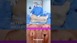 BBL + 360 Lipo Surgery Results | Before & After That Speak for Themselves!