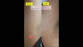 Dr. Madan's Clinic (Skin aesthetic Aesthetic Hair & Laser) ## Stretch Marks Treatment