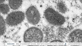 Logan Health doctor describes signs of monkeypox, no cases found in Montana