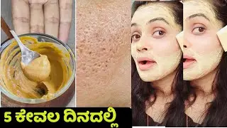 ಎಷ್ಟೇ ಹಳೆಯ OPEN PORES, LARGE PORES, CLOGGED PORES ಇರಲಿ, ಈ Remedy ಯಿಂದ 100% ಗುಣ ಆಗುತ್ತೆ