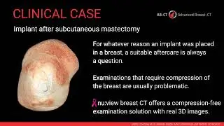 nu:view Breast CT: Breast Implants after subcutaneous mastectomy