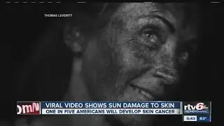 Video: UV camera shows harsh realities of sun damage