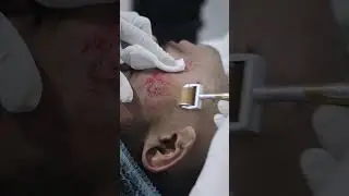 Acne treatment With Derma roller at Skinaa Clinic: witness the amazing effects of Derma roller#short