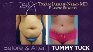 Tummy Tuck Before & Afters | Dr. J Plastic Surgery | Payam Jarrah-Nejad