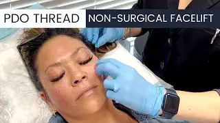 Tighten & Lift with a PDO Thread Lift