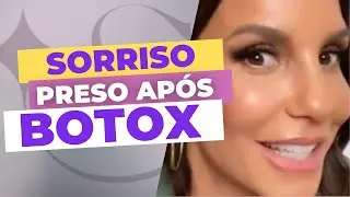 SÉRIE: IVETE SANGALO: SORRISO PRESO APÓS BOTOX  - Dra. Joana Costa