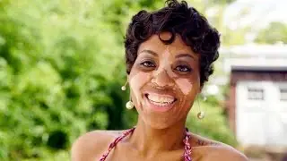 Black and White Skin: Body Positive Mum Owns Her Vitiligo Condition