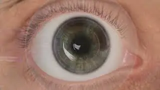 LASIK using the Alcon WaveLight Refractive Suite