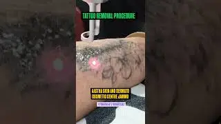 Permanent Tattoo Removal in Jammu &ndash; Painless, Scar-Free Laser Treatment