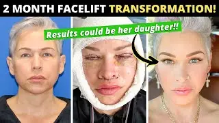 49-летняя женщина повернула время вспять на 10 лет с помощью подтяжки лица и губ! Двухмесячный пу...