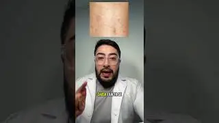Pitiriasis rosada de Gibert #dermatologia #skincare #piel #pitiriasisrosada