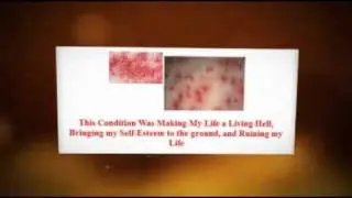 Pityrosporum Folliculitis Treatment, Proven Cure