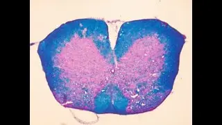 Luxol Fast Blue (LFB) is a histological stain to identify myelin in nervous tissue And Demyelination