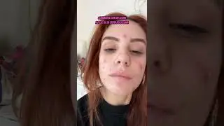 EMILY PALLINI E IL SUO RAPPORTO CON L&rsquo;ACNE #tiktok #perte #webboh  #relatable