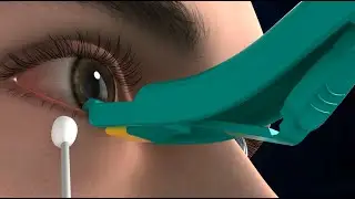 Meibomian Gland Expressor