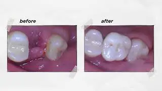Live Comfortably with Dental Implant! | Angela Leung DDS PC