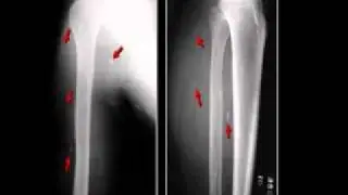 LearningRadiology 27 Soft Tissue Calcifications II