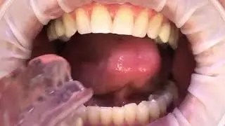 Sleep Apnea Somnodent device