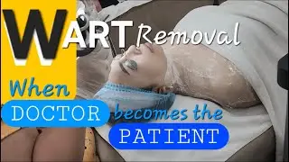 LASER VS CAUTERY? MY PERSONAL EXPERIENCE ON WART REMOVAL #doctorexplains