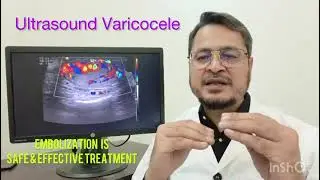 Varicocele embolization ویریکوسیل  ایمبولائزیشن