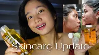 SKINCARE UPDATE AFTER A LONG ACNE JOURNEY