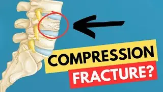 Compression Fracture: How it happens- what is it?