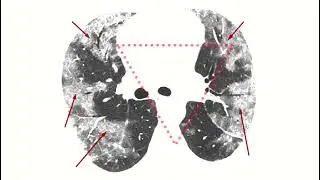 Ground-Glass Opacification (GGO)