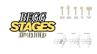 BEGG TECHNIQUE STAGES |An overview of stages of BEGG technique in Orthodontics|