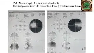 Perimetry Strategies - GLADv (Glaucoma Learning And Diagnostic Videos) #4 by Dr Kirti Singh