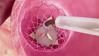 Transcatheter Aortic Valve Replacement