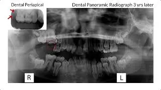 The Video Atlas | Cystic Ameloblastic Fibroma