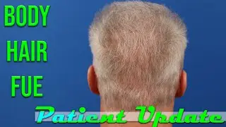 Body Hair Transplant - Results and Patient Update with Ricky