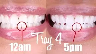 WK 9 (Clear Braces): Tray 3 Update + Tray 4 Try-on | SmileDirectClub | Kyma Monai