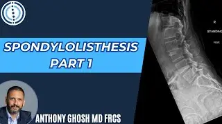 What is Spondylolisthesis? - Spine surgeon explains